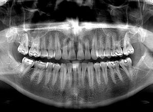 Radiografia-panoramica