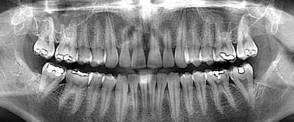 Radiografia-panoramica