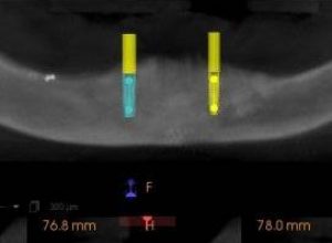 thumb1_Metodo_de_haz_conico_implantes_g